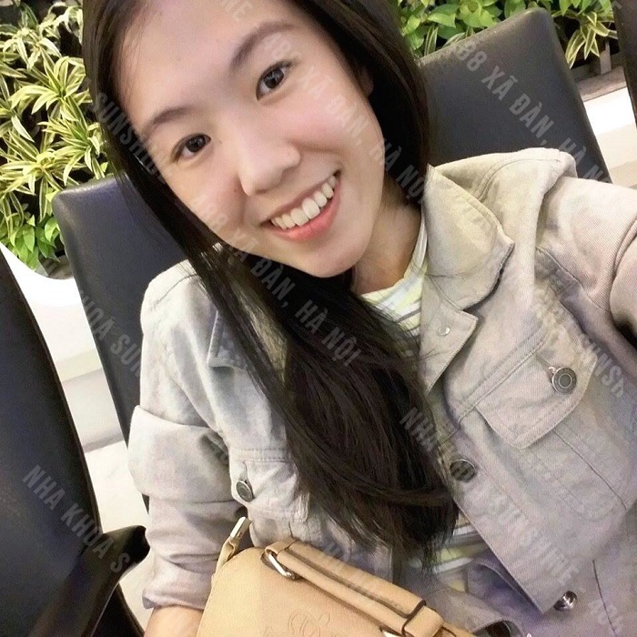 trồng răng hàm trong cùng trồng răng hàm trong cùng