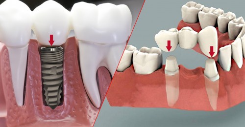 trồng răng khểnh giá rẻ trồng răng khểnh giá rẻ