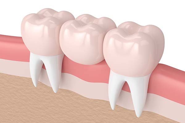 trồng răng khểnh giá rẻ trồng răng khểnh giá rẻ