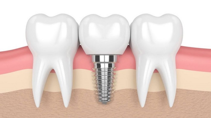 trồng răng khểnh giá rẻ trồng răng khểnh giá rẻ