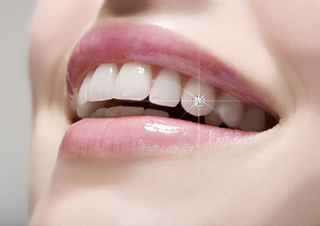 trồng răng khểnh hết bao nhiêu tiền