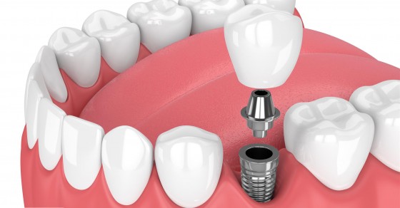 trồng răng số 6 hàm dưới trồng răng số 6 hàm dưới