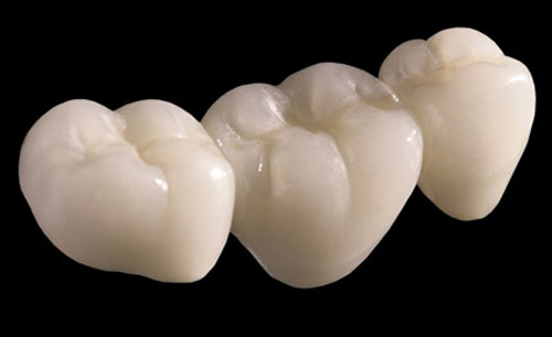 trồng răng sứ bị đen chân răng