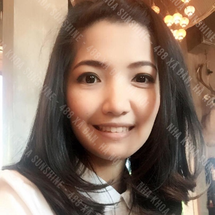 trồng răng sứ số 6 trồng răng sứ số 6