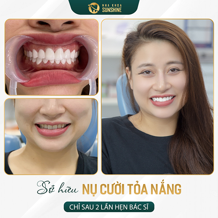 Hình Ảnh trước vào sau khi làm bọc răng sứ cercon