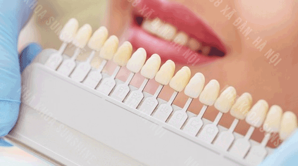 ưu điểm của bọc răng sứ thẩm mỹ
