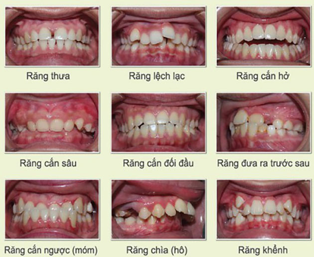 Truong-hop-nen-nieng-rang