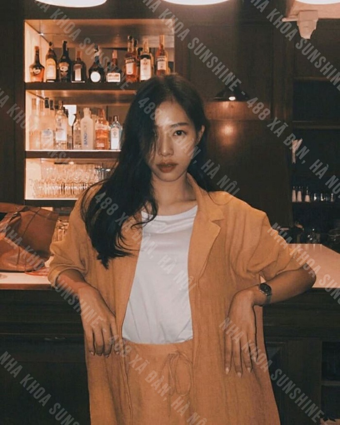 chi phí niềng răng hàm dưới