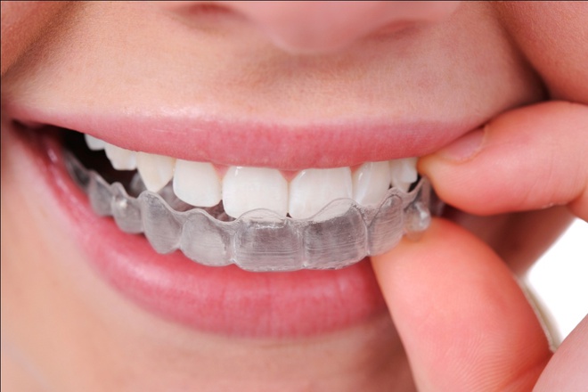 chữa răng hô nhẹ không cần niềng