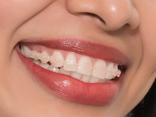 có nên niềng răng mắc cài sứ không có nên niềng răng mắc cài sứ không