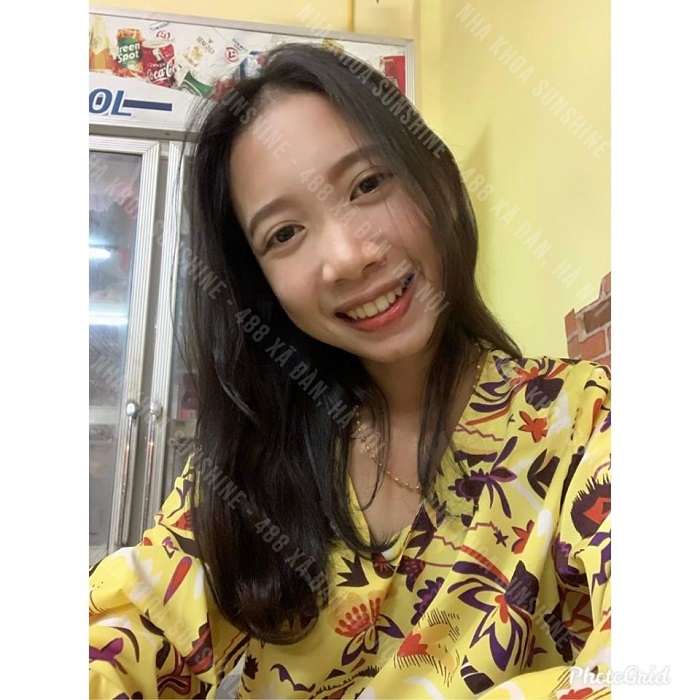 có thể niềng răng 1 hàm không