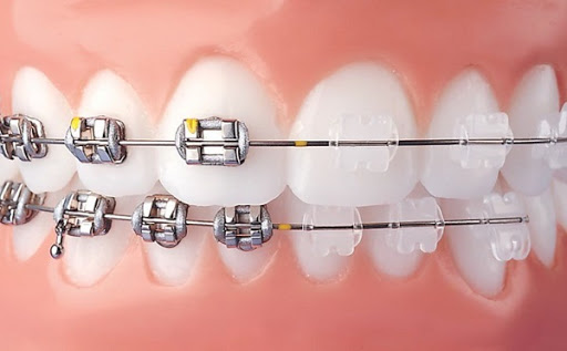 dây cung trong niềng răng có tác dụng gì