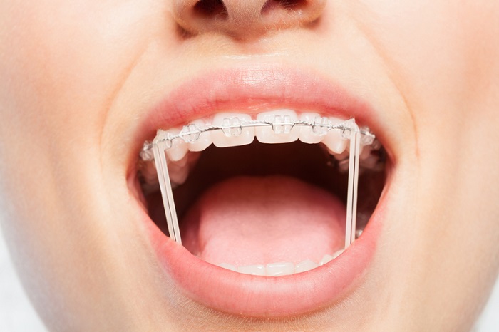 dây thun niềng răng có tác dụng gì