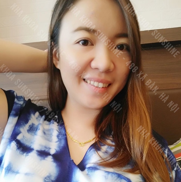 giá cả trồng răng Implant