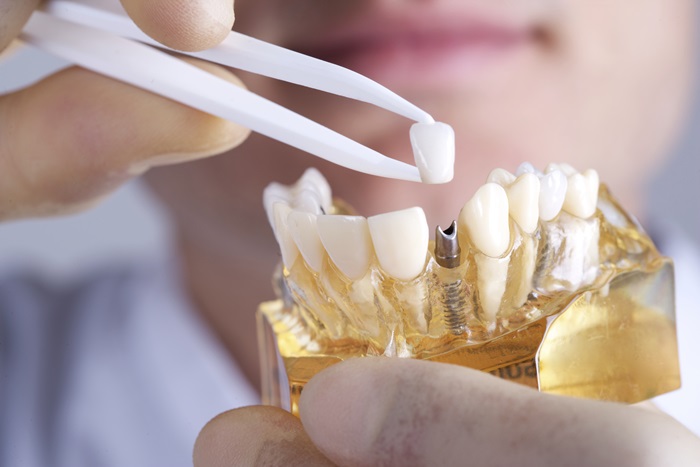 giá trồng răng bằng phương pháp Implant