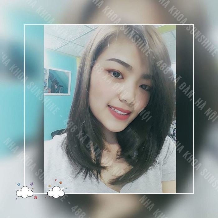 nhổ răng bao lâu thì trồng Implant