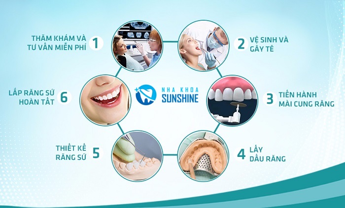 niềng răng 4 năm