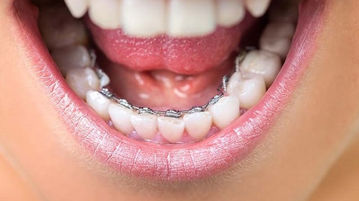 niềng răng bên trong hàm