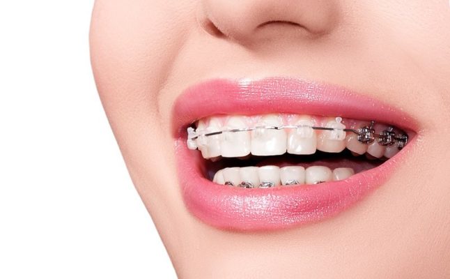 niềng răng có ảnh hưởng gì về sau không