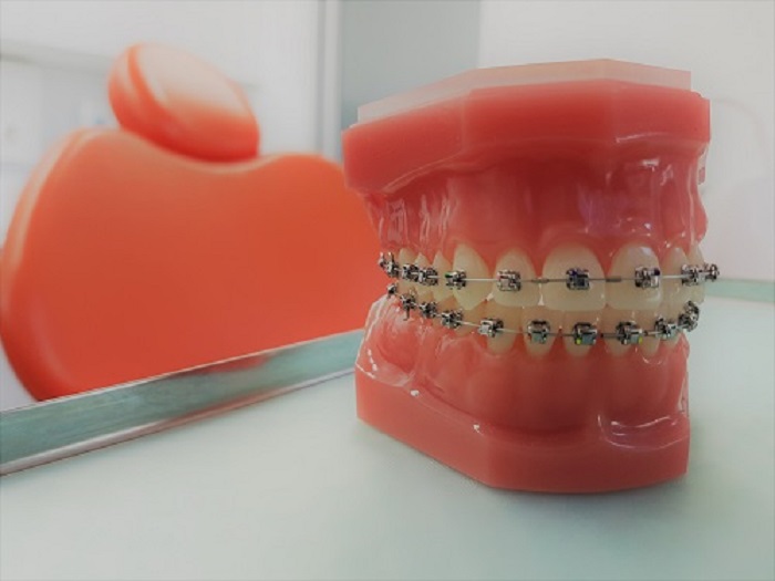 niềng răng có giảm hô hàm không