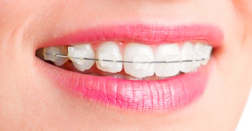 niềng răng có mấy loại