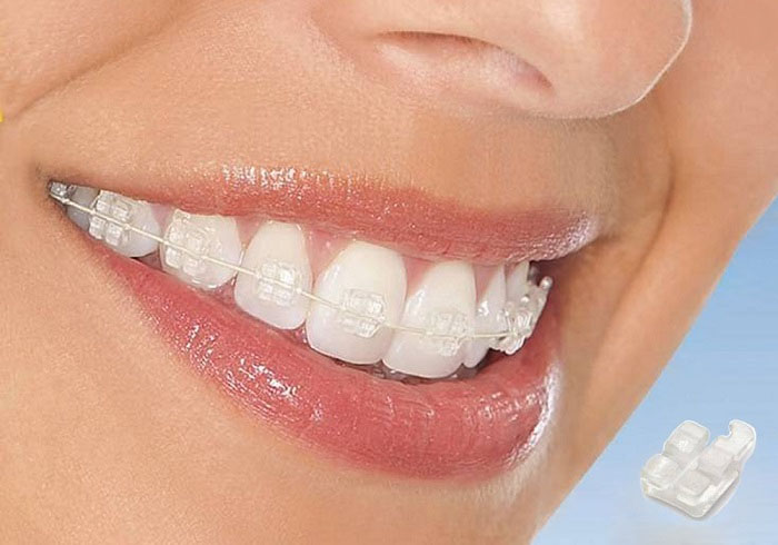 niềng răng có mấy loại