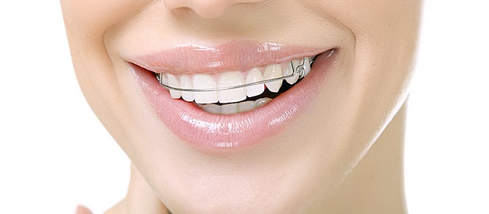 niềng răng đeo hàm duy trì bao lâu