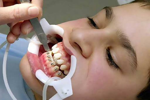 niềng răng hàm dưới mất bao lâu
