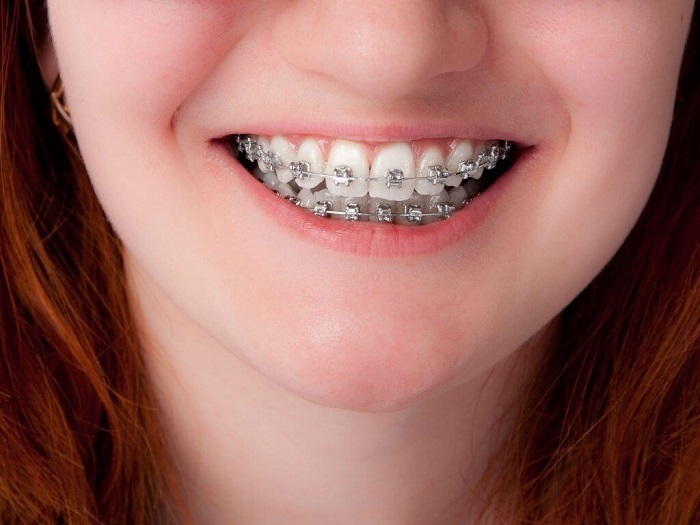 niềng răng mắc cài kim loại là gì