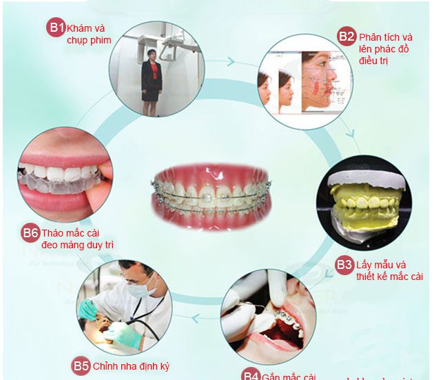 niềng răng mắc cài sứ bao lâu