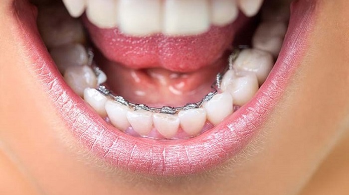 niềng răng mặt trong giá bao nhiêu tiền