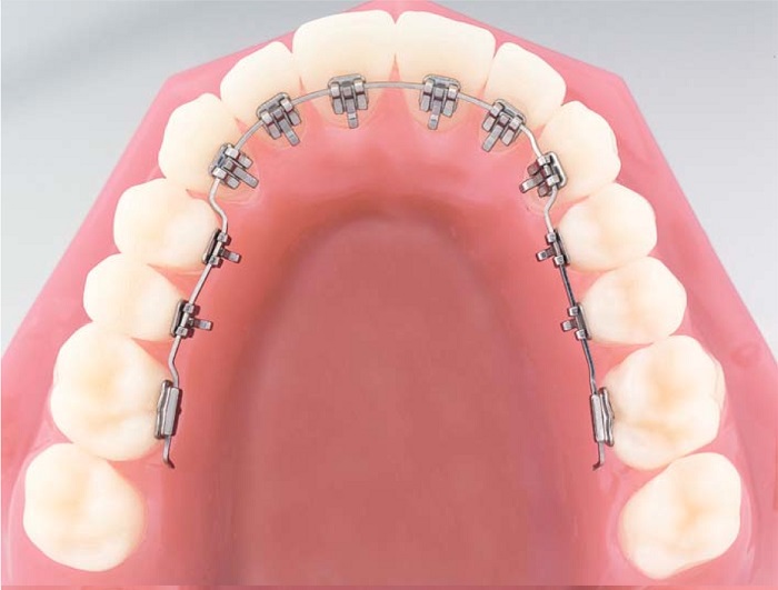 niềng răng mặt trong giá bao nhiêu tiền