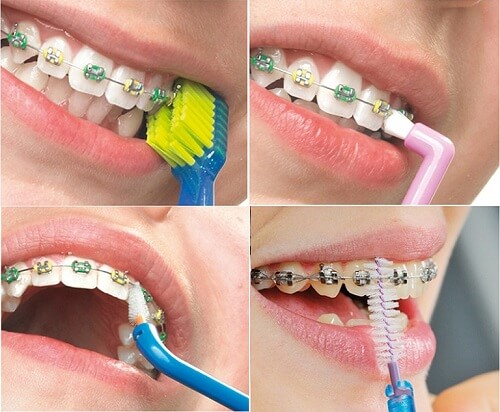 niềng răng nên dùng bàn chải gì