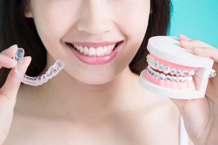 niềng răng tại nhà silicon