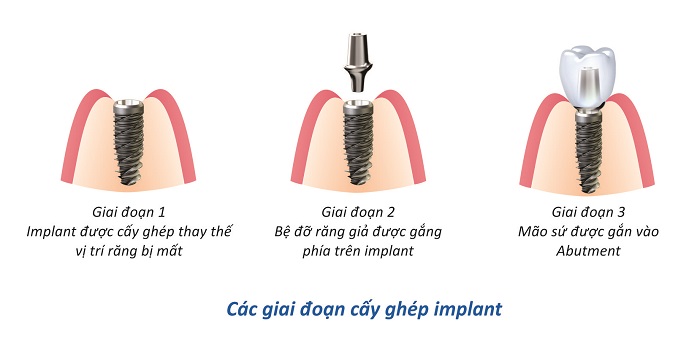 trồng 1 răng Implant giá bao nhiêu