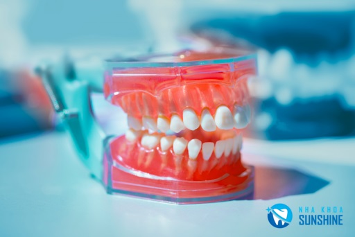 trồng răng giả bằng hàm tháo lắp trồng răng giả bằng hàm tháo lắp