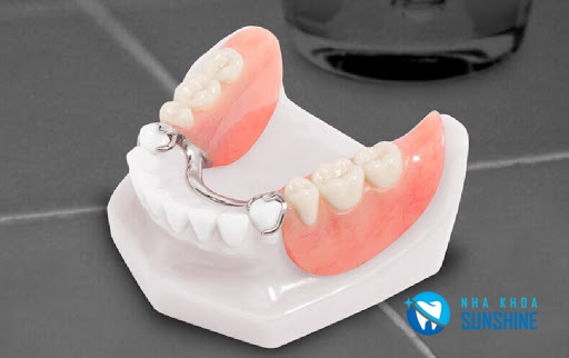 trồng răng giả bằng hàm tháo lắp trồng răng giả bằng hàm tháo lắp