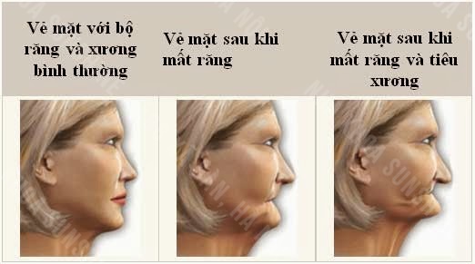 trồng răng giả bằng hàm tháo lắp trồng răng giả bằng hàm tháo lắp