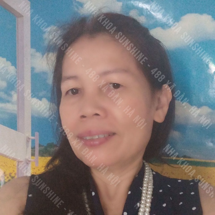 trồng răng giả Implant giá bao nhiêu