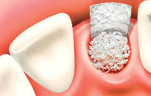 trồng răng hàm giả cố định