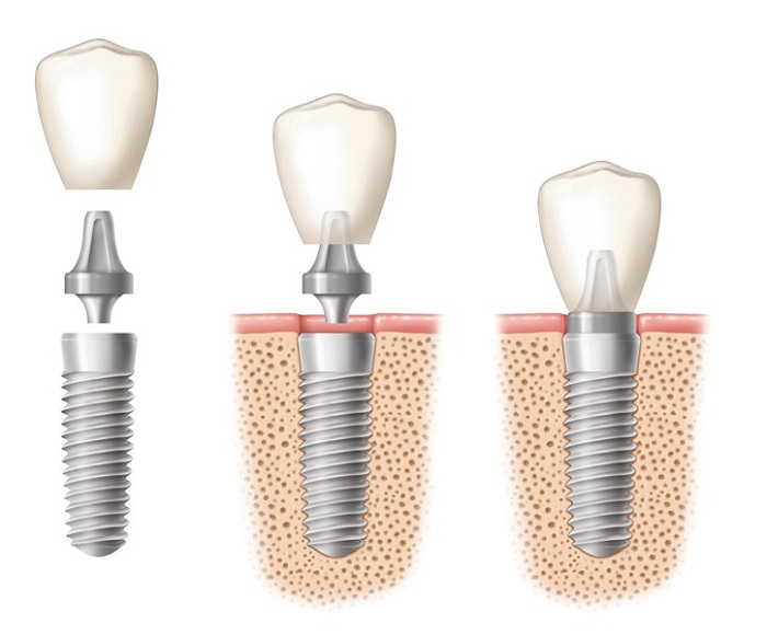 trồng răng hàm Implant giá bao nhiêu trồng răng hàm Implant giá bao nhiêu