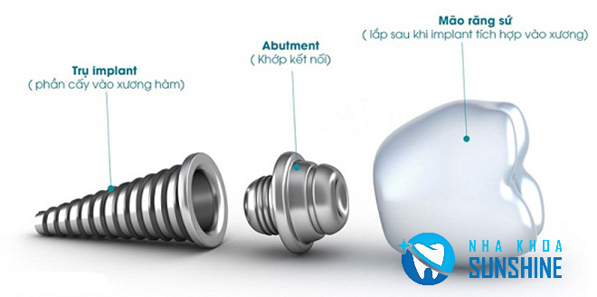 trồng răng Implant cần thơ