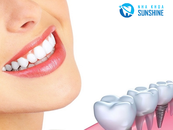 trồng răng Implant cần thơ