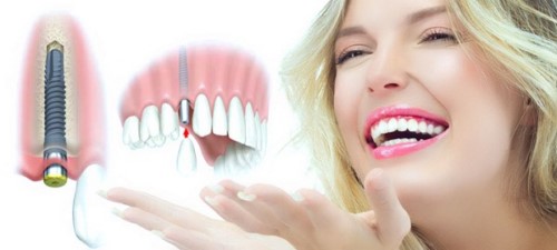 trồng răng Implant cho người già