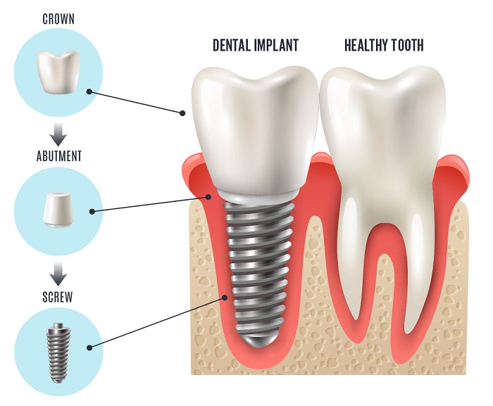 trồng răng Implant có bị hôi miệng không