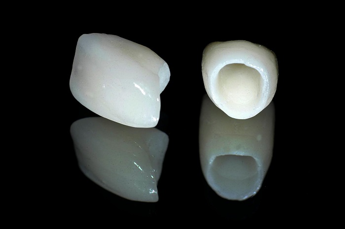 trồng răng Implant có bị hôi miệng không