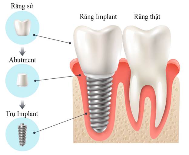 trồng răng Implant có đau không trồng răng Implant có đau không
