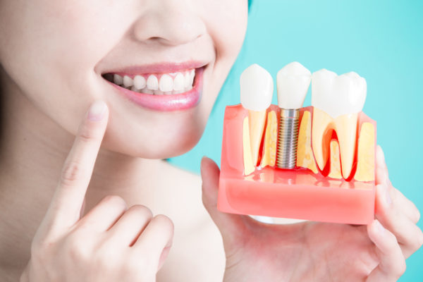 trồng răng Implant có đau không trồng răng Implant có đau không