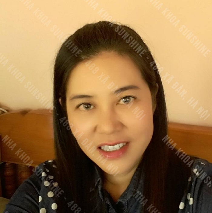 trồng răng Implant có lâu không