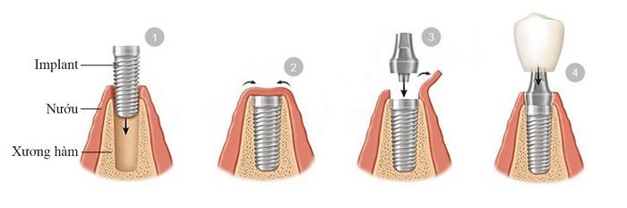 trồng răng Implant là gì